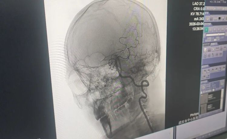 武汉33岁男子按摩后突发脑梗！提醒：高危按摩动作务必远离